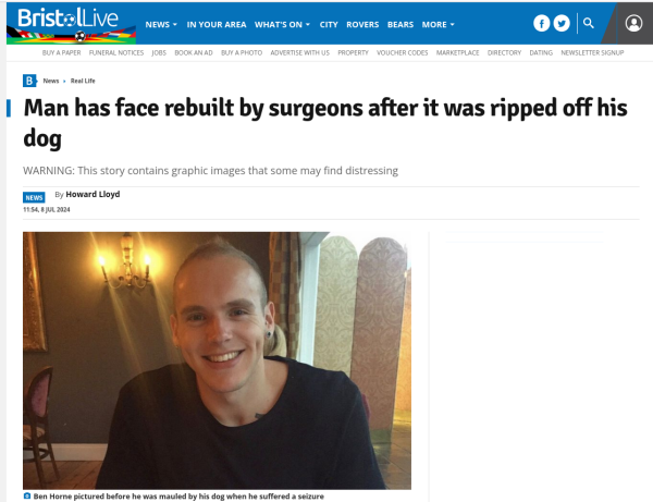 Headline reads Man has face rebuilt by surgeons after it was ripped off his dog.